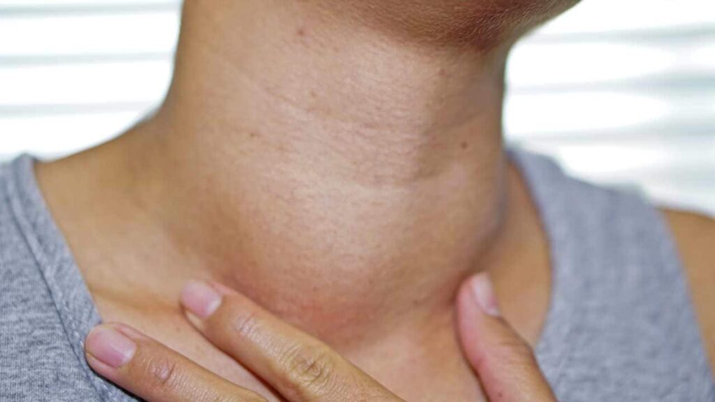 cancer swollen lymph nodes
