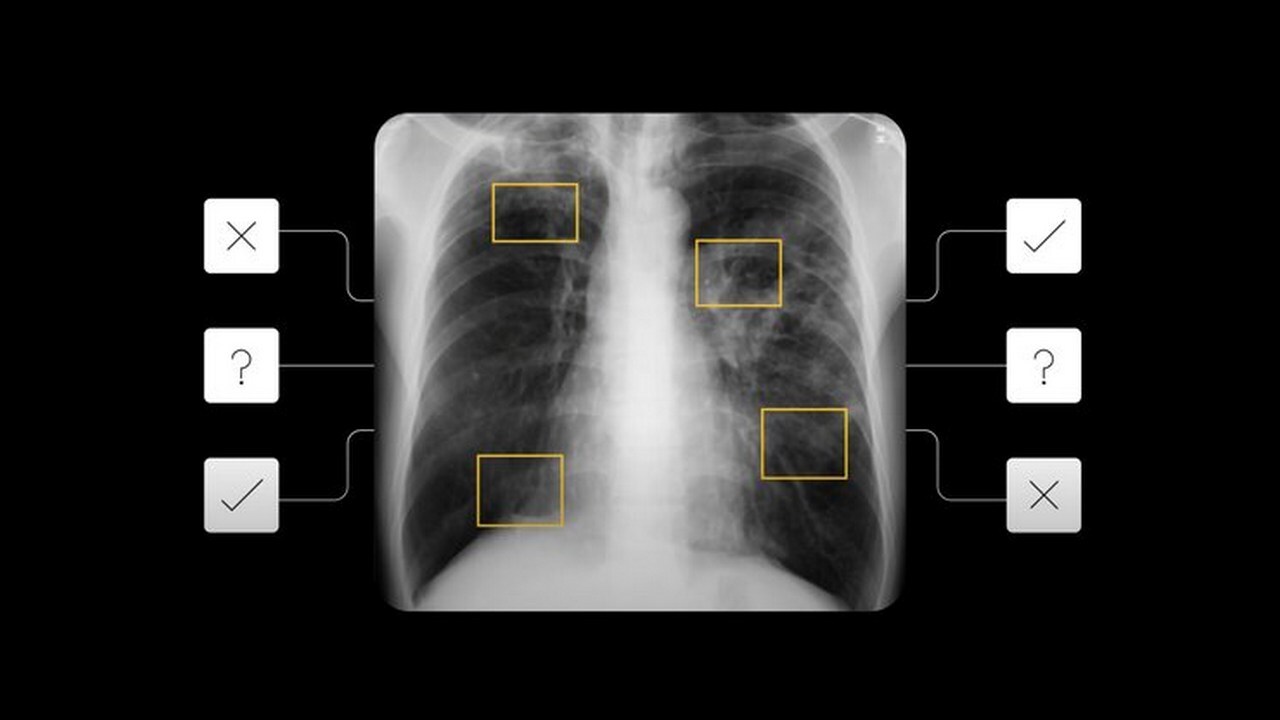 You are currently viewing AI tool to detect active pulmonary tuberculosis announced- Technology News, FP