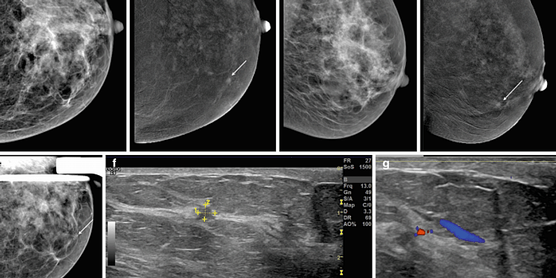 You are currently viewing AI Detects Breast Cancer Earlier: Cardiff University's Breakthrough